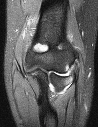 Figure 3 for case Tear of combined origin of the lateral ulnar collateral ligament and radial collateral of elbow (RID2043)(RID2035)